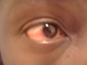 Right eye Whoa, there's a line of redness there...
