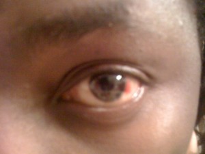 Left eye This one's not so bad.